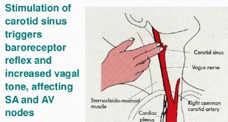 Carotid Sinus 